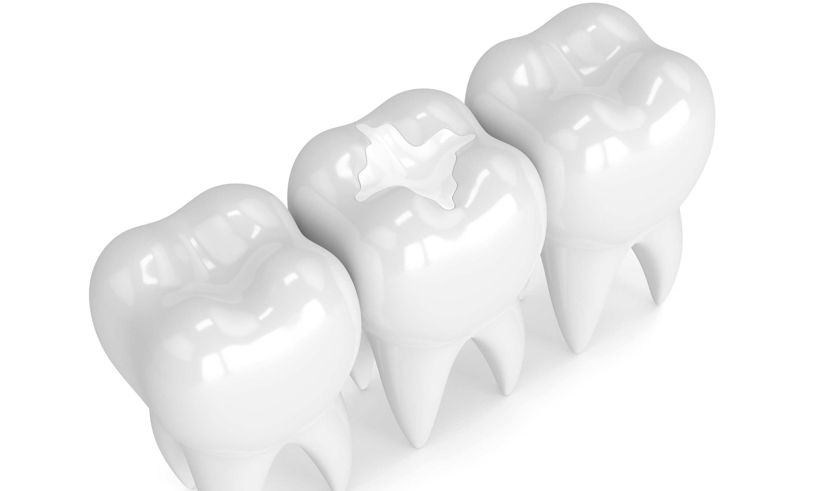 Can a Tooth With A Filling Get a Cavity? - Family Tree Dental