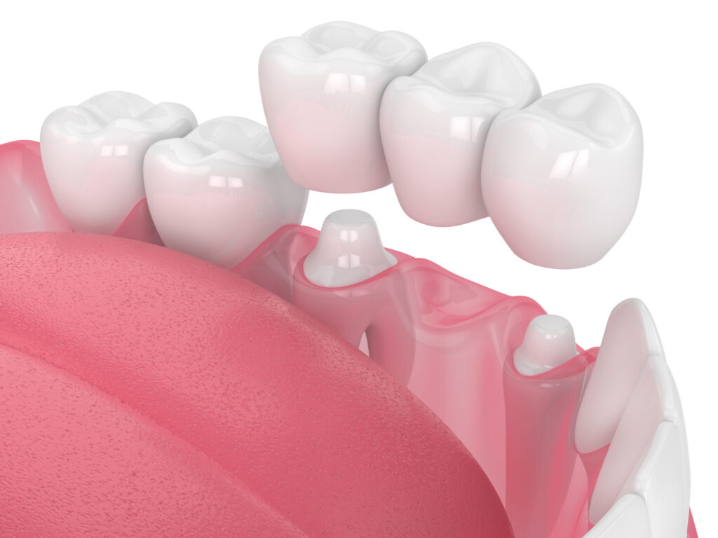 grand prairie dental bridge
