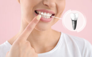 grand prairie dental implants