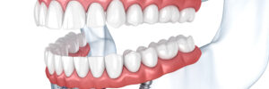 grand prairie prosthetic dentistry