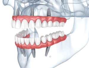 grand prairie prosthetic dentistry