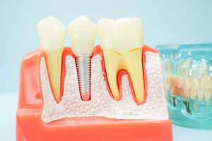 grand prairie restorative dentistry