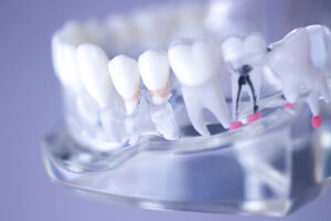 grand prairie root canal