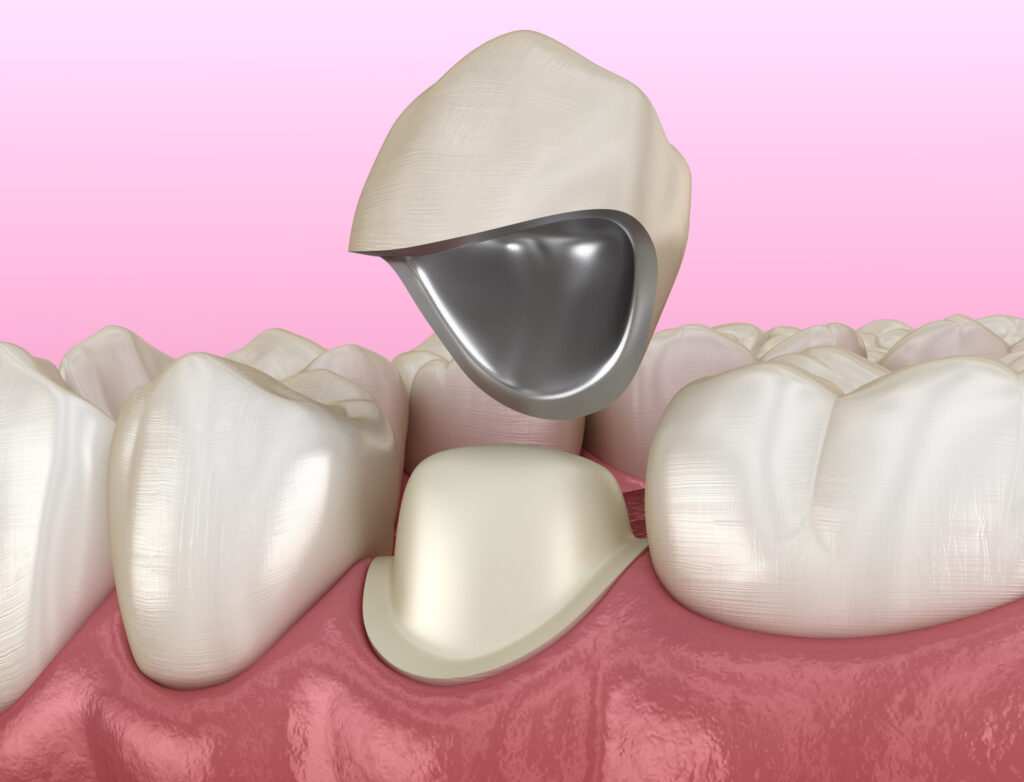 grand prairie dental crowns