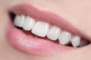 grand prairie dental fillings