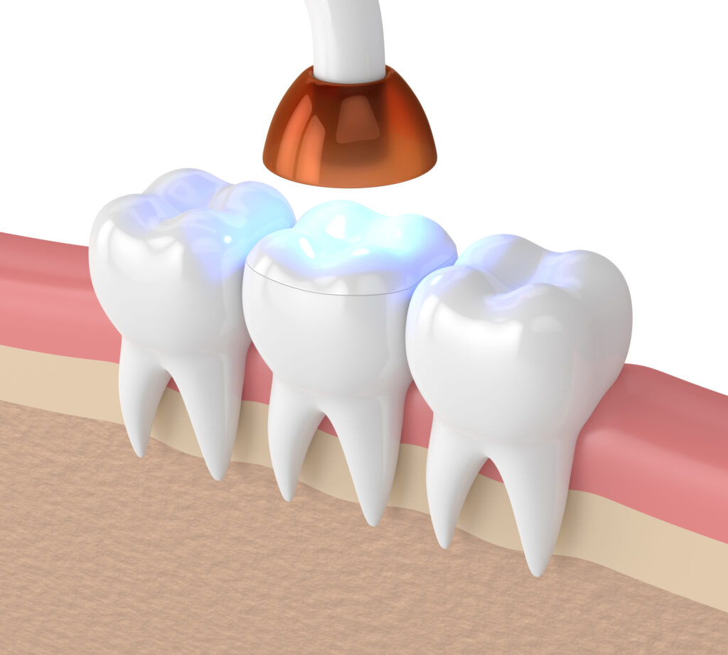 grand prairie dental bonding