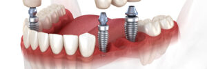 grand prairie dental bridge