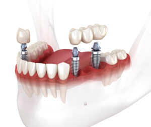 grand prairie dental bridge
