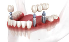 grand prairie dental bridge