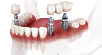 A Dental Bridge Offers A Full Smile Again