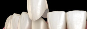 grand prairie dental crown