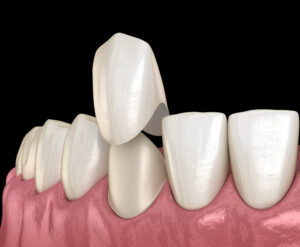 grand prairie dental crown