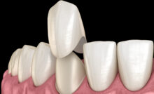 grand prairie dental crown