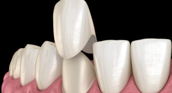 Dental Crowns Offer Your Smile Lifelike Repair