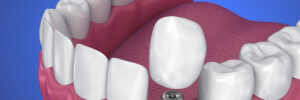 grand prairie prosthetic dentistry