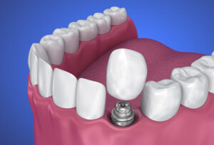 grand prairie prosthetic dentistry