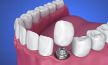 grand prairie prosthetic dentistry
