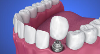 Your Smile Can Be Complete With Prosthetic Dentistry