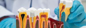 grand prairie root canal