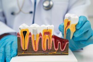 grand prairie root canal