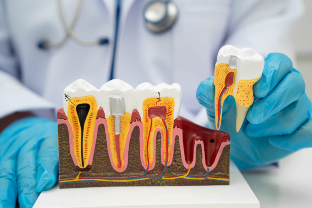 grand prairie root canal