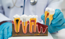 grand prairie root canal
