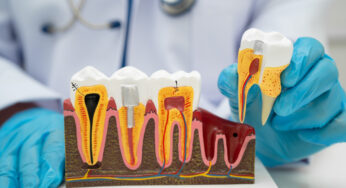 Using A Root Canal To Keep Your Smile Whole