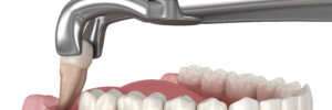 grand prairie tooth extraction