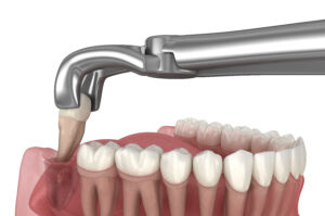 grand prairie tooth extraction
