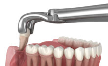 grand prairie tooth extraction