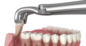 Why We May Need To Extract A Tooth