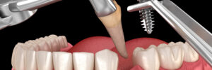 grand prairie tooth extraction
