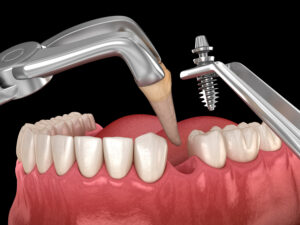 grand prairie tooth extraction