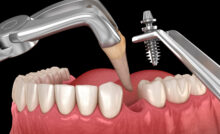 grand prairie tooth extraction