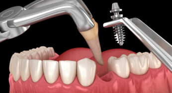How Tooth Extraction Could Protect Your Oral Health