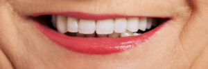 grand prairie full mouth rehabilitation