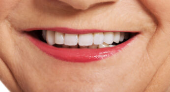 Time For A Full Smile Rehabilitation?