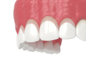grand prairie gum contouring