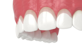 Boosting Your Smile With Gum Contouring