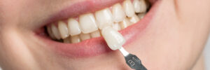 grand prairie porcelain veneers