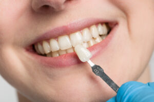 grand prairie porcelain veneers