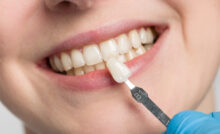 grand prairie porcelain veneers