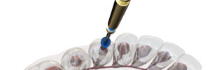 grand prairie root canal