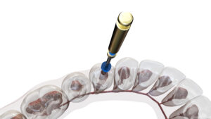 grand prairie root canal