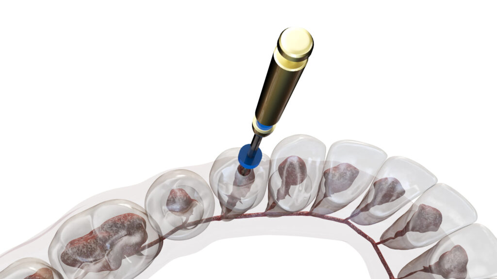 grand prairie root canal