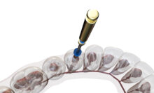 grand prairie root canal