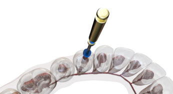Stopping Painful Infection With A Root Canal