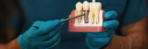 grand prairie dental implants