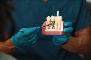 grand prairie dental implants