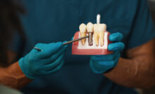 grand prairie dental implants